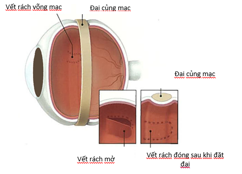 phẫu thuật điều trị các bệnh lý dịch kính võng mac