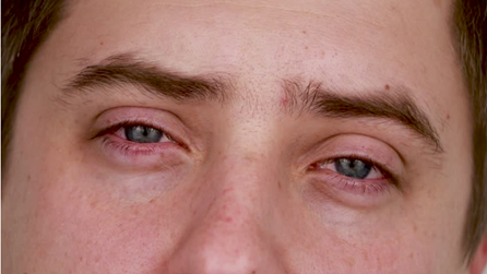 Mắt “Dại” Do Cận Thị: Hiểu Đúng Nguyên Nhân – Điều Trị Đúng Cách