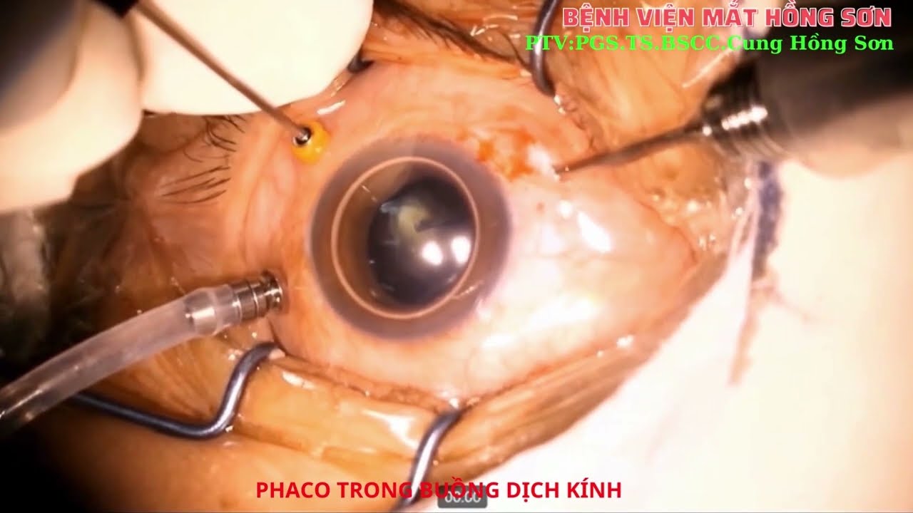 Phaco trong buồng dịch kính + Treo thuỷ tinh thể nhân tạo không khâu bằng kĩ thuật Yamane  (Phacoemulsification in vitreous cavity and sutureless IOL fixation - Yamane technique) 