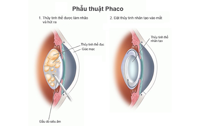 Phẫu thuật Phaco ở Bệnh viện Mắt Hồng Sơn - phương pháp hiệu quả điều trị bệnh đục thủy tinh thể